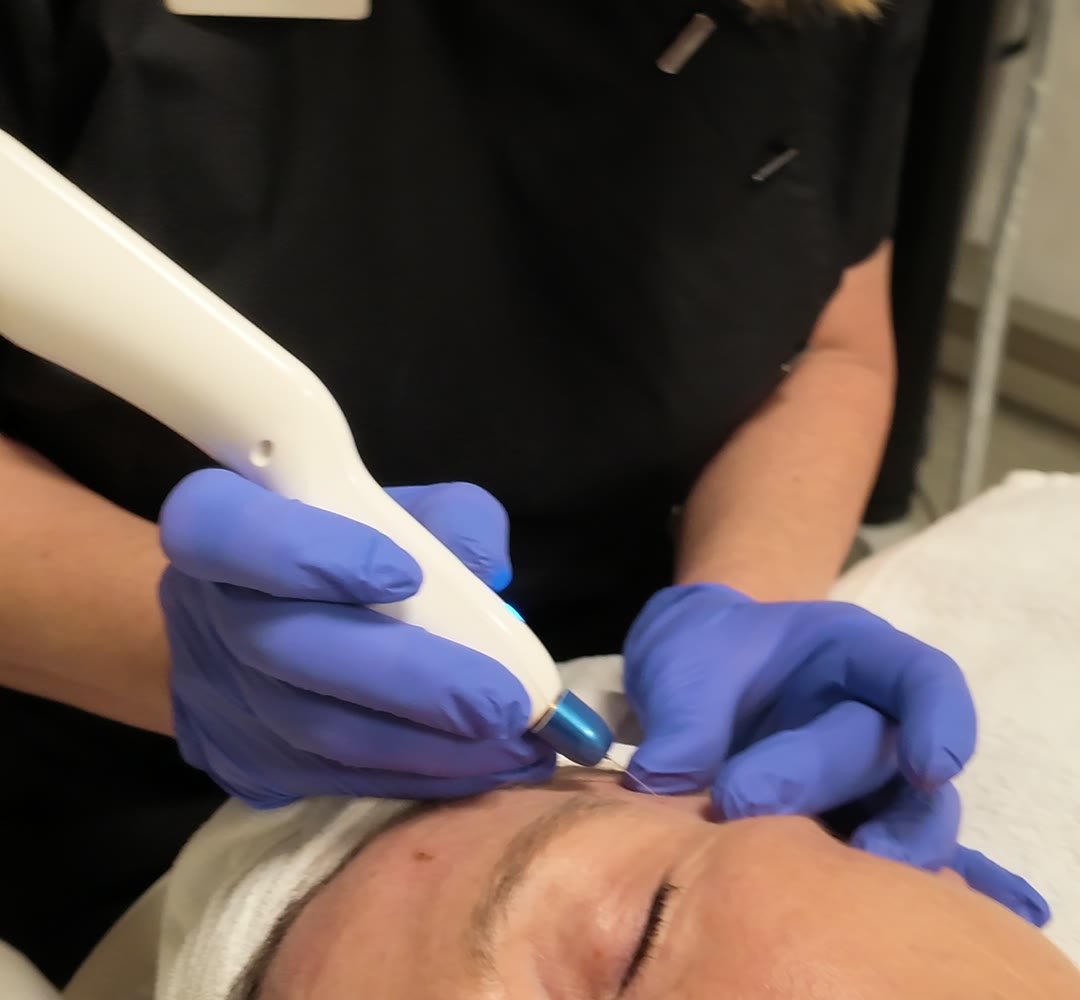 Annica tar bort hudflikar med Plaxpot hos Eriksbergs Hälsoklinik